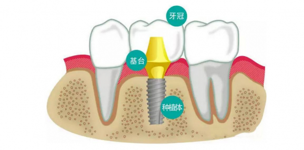 灵魂拷问，到底是先种牙还是先矫正？