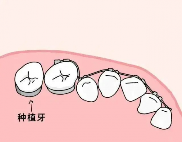 灵魂拷问，到底是先种牙还是先矫正？
